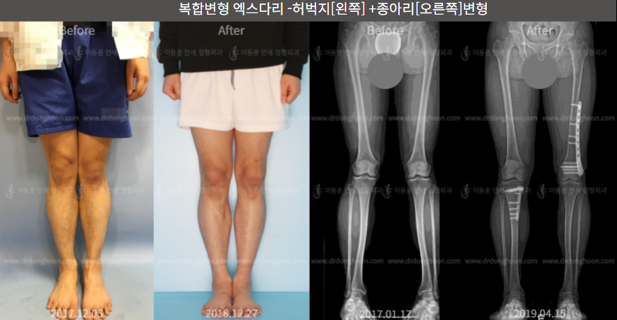 복합변형 엑스다리 - 허벅지[왼쪽] + 종아리[오른쪽] 변형