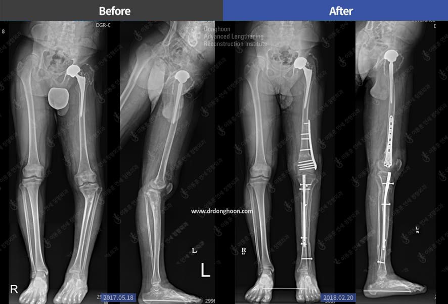 leg length discrepancy, bow leg, and genu recurvatum deformity- treated by tibial lengthening(LON) and correctional osteotomy