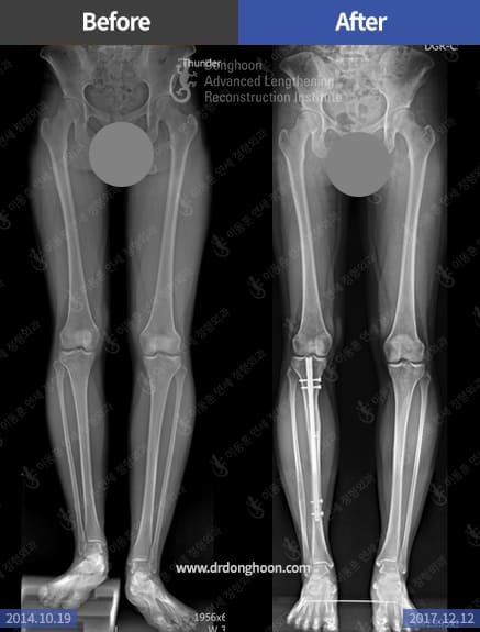 Simultaneous correction of leg length discrepancy and bowleg