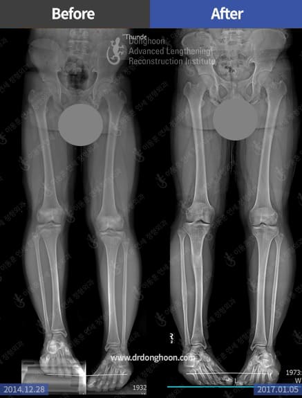 Congenital hemihypertrophy – leg length discrepancy- treated by Ilizarov lengthening