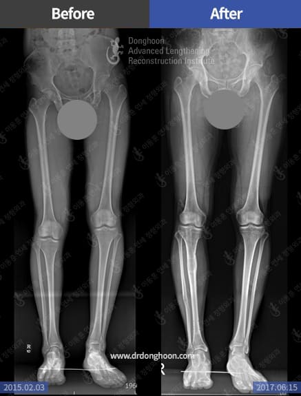Fibular hemimelia – leg length discrepancy- treated by LON
