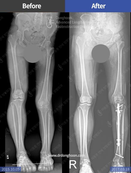 하지부동 및 엑스자 다리를 종아리연장 및 변형교정을 통하여 동시에 치료함.