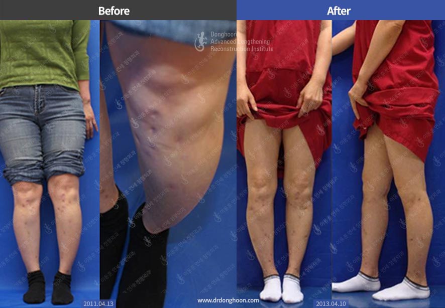 타병원 키수술 후 발생한 다리변형(왼쪽다리)을 치료함